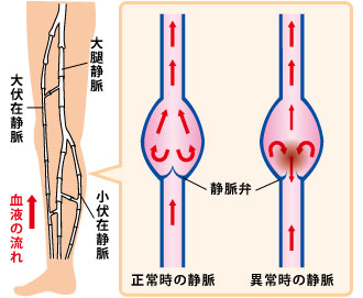 下肢静脈瘤の原因は？